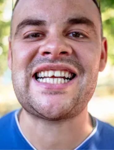 chipped teeth